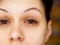 depositphotos.com/offstocker2: женщина с воспаленными глазами