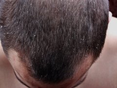 ru.depositphotos.com/Adam88xxx: перхоть на волосах